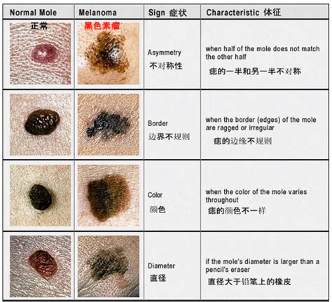 陰囊 痣|陰囊痣的5大誤區，你中了嗎